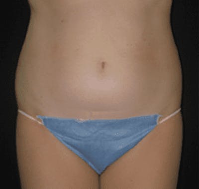 UltraShape Before & After Gallery - Patient 55345147 - Image 1