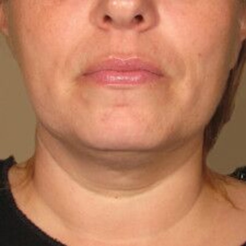 Ultherapy Before & After Gallery - Patient 55345146 - Image 2