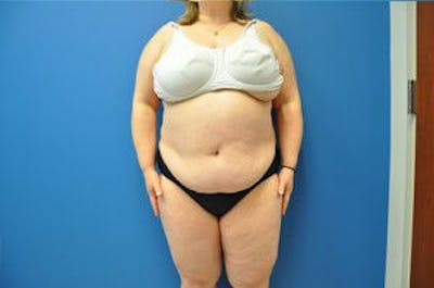 Liposonix Before & After Gallery - Patient 55345165 - Image 2