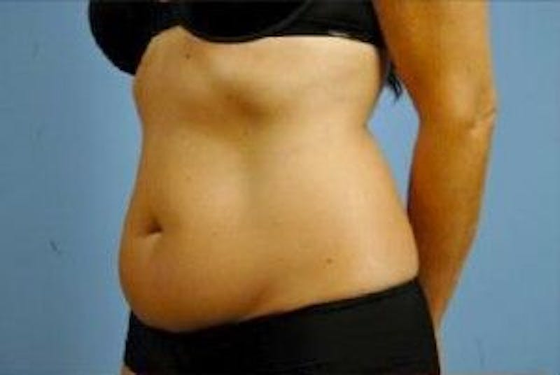 truSculpt Before & After Gallery - Patient 55345148 - Image 3