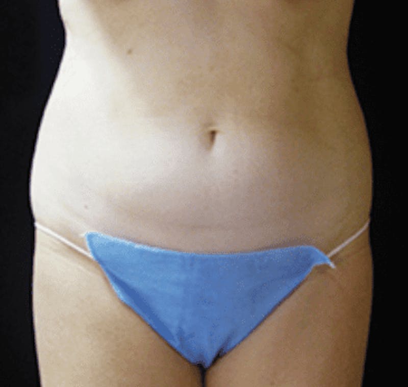 UltraShape Before & After Gallery - Patient 55345147 - Image 2