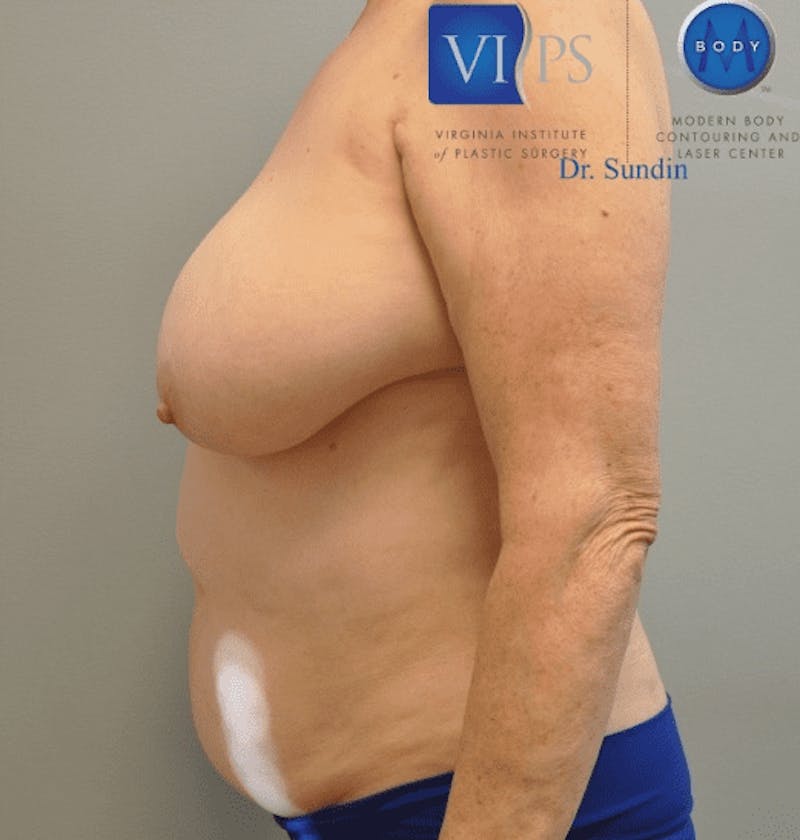 JPlasma Before & After Gallery - Patient 55345157 - Image 7