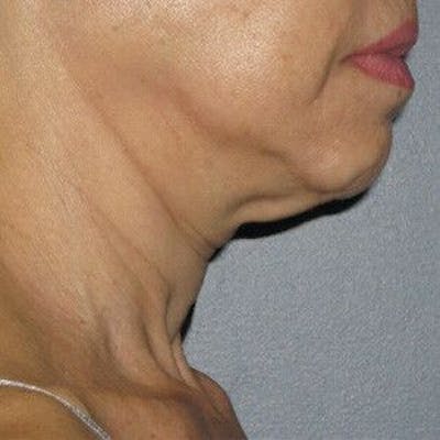Ultherapy Before & After Gallery - Patient 55345149 - Image 1