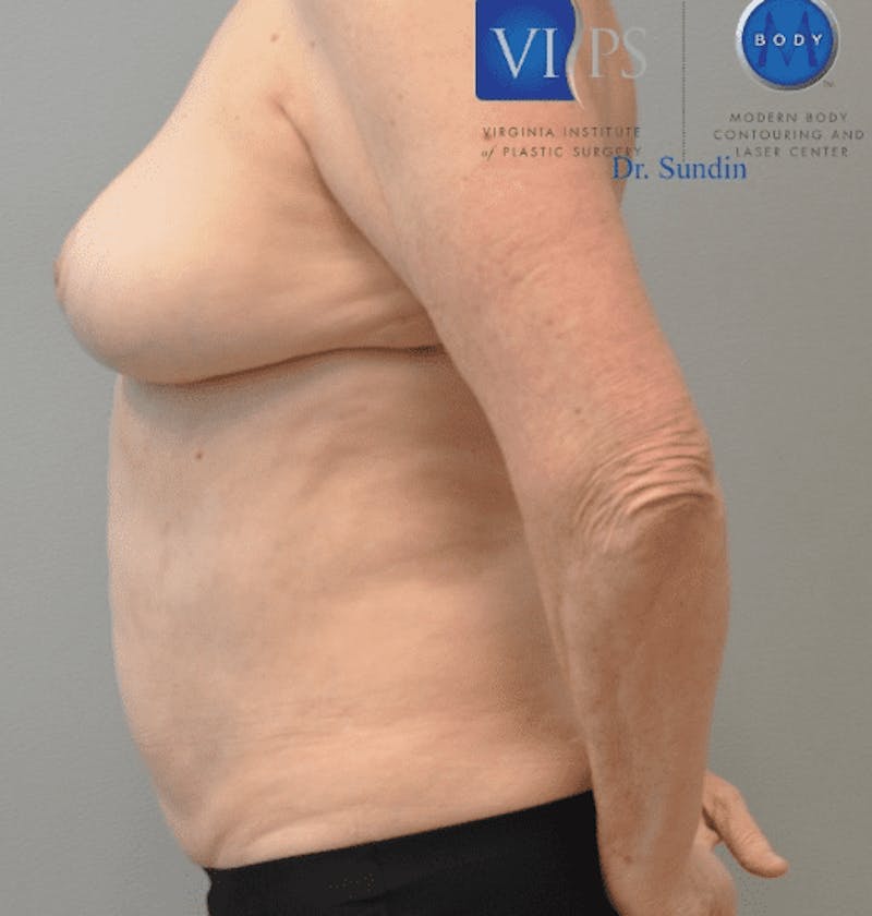 JPlasma Before & After Gallery - Patient 55345157 - Image 8