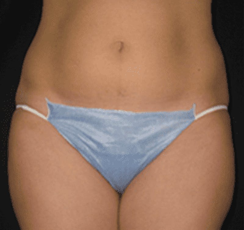 UltraShape Before & After Gallery - Patient 55345150 - Image 1