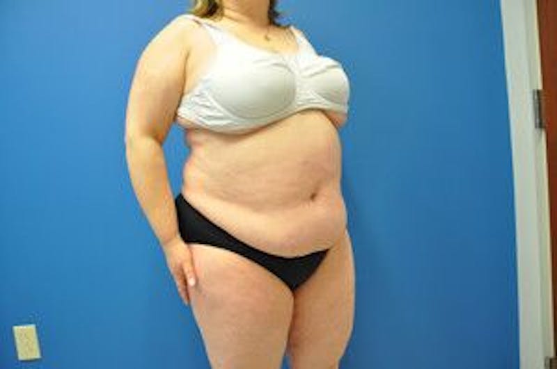 Liposonix Before & After Gallery - Patient 55345165 - Image 4