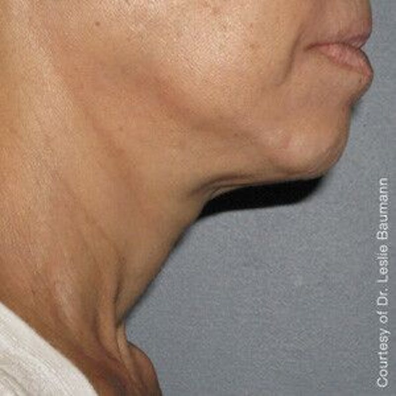 Ultherapy Before & After Gallery - Patient 55345149 - Image 2