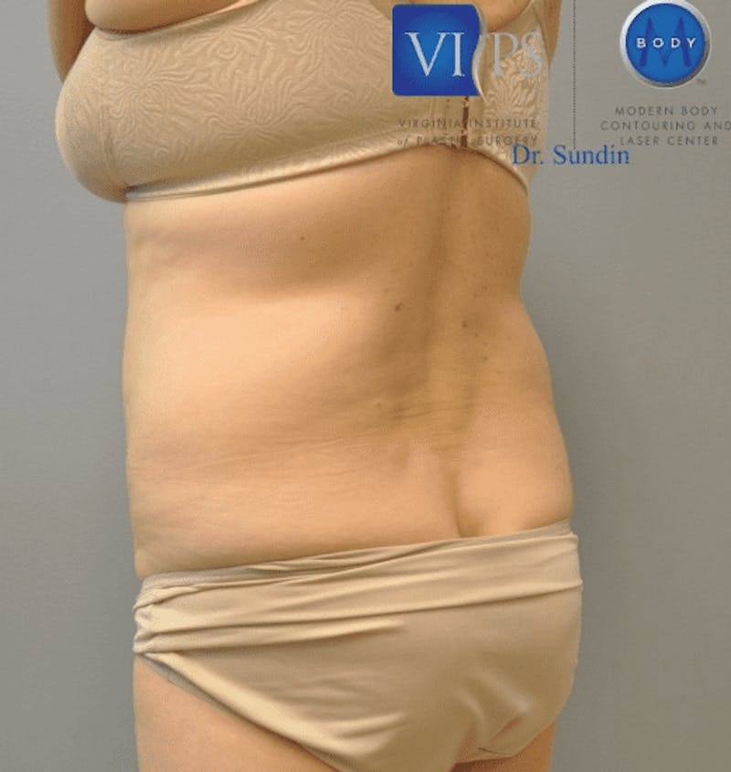 JPlasma Before & After Gallery - Patient 55345157 - Image 9