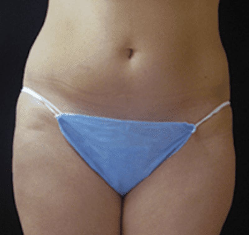 UltraShape Before & After Gallery - Patient 55345150 - Image 2