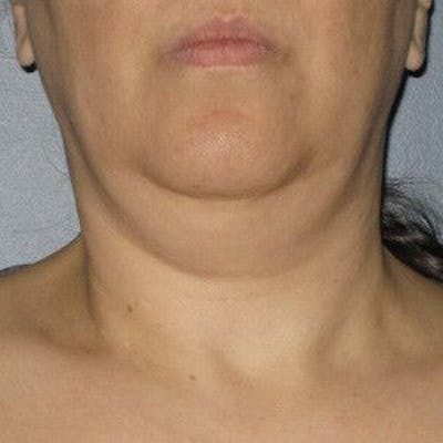Ultherapy Before & After Gallery - Patient 55345151 - Image 1
