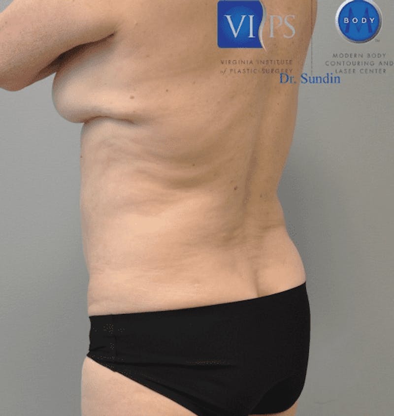 JPlasma Before & After Gallery - Patient 55345157 - Image 10