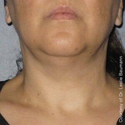 Ultherapy Gallery - Patient 55345151 - Image 2