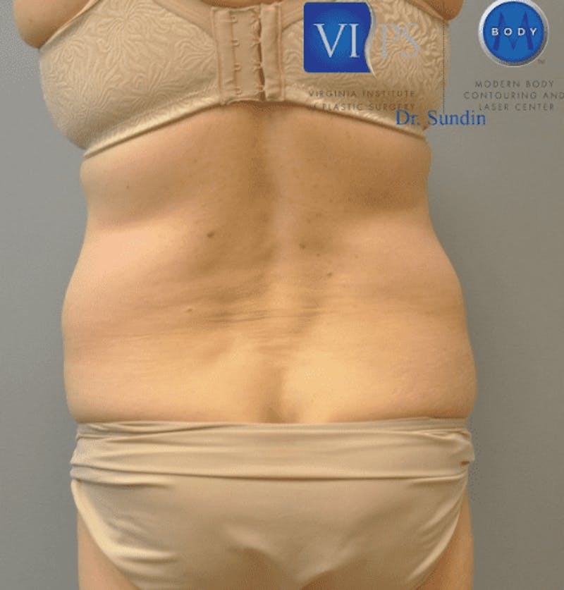 JPlasma Before & After Gallery - Patient 55345157 - Image 11