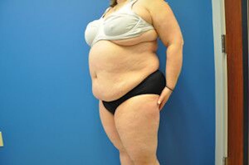 Liposonix Before & After Gallery - Patient 55345165 - Image 8