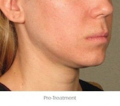 Ultherapy Before & After Gallery - Patient 55345158 - Image 1