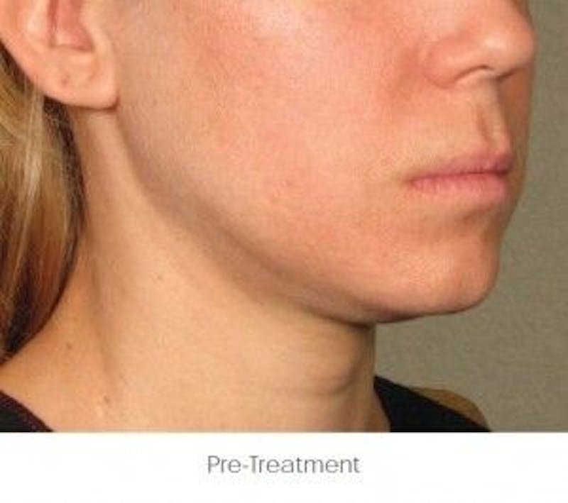 Ultherapy Before & After Gallery - Patient 55345158 - Image 1