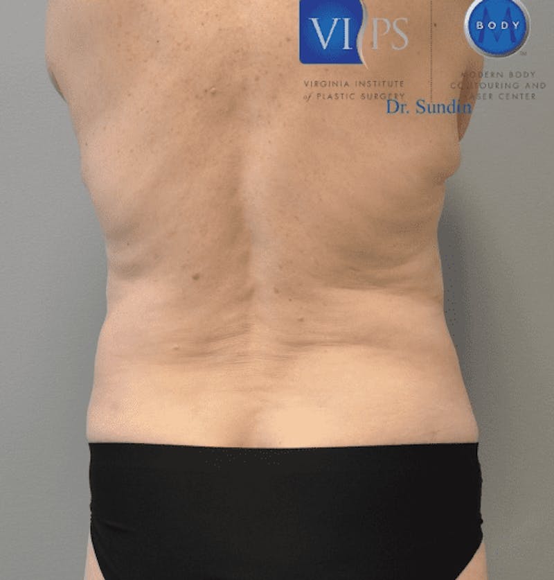 JPlasma Before & After Gallery - Patient 55345157 - Image 12