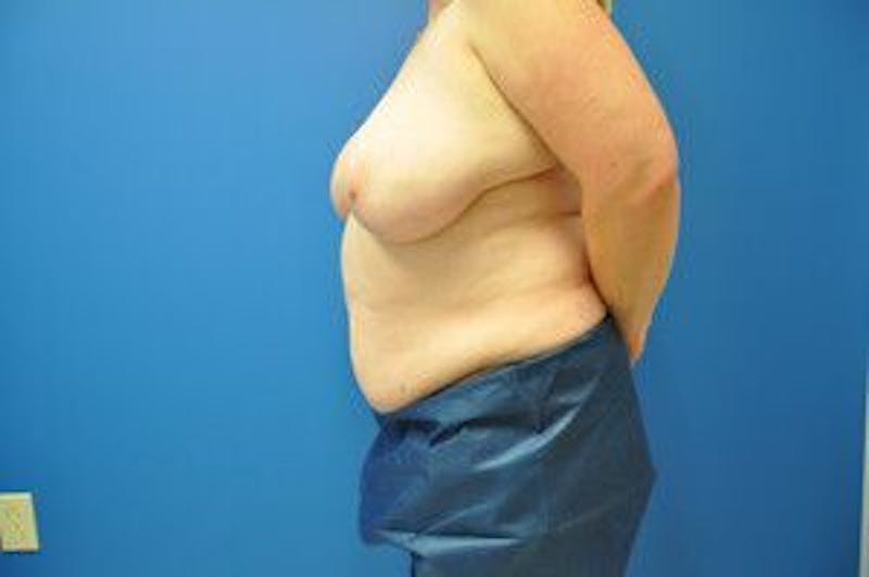 Liposonix Before & After Gallery - Patient 55345165 - Image 9