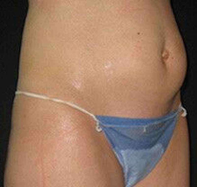 UltraShape Before & After Gallery - Patient 55345159 - Image 1