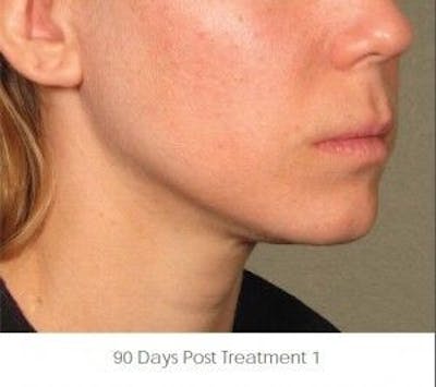 Ultherapy Before & After Gallery - Patient 55345158 - Image 2