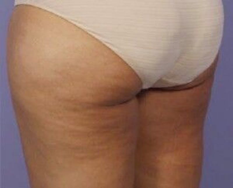 truSculpt Before & After Gallery - Patient 55345161 - Image 2