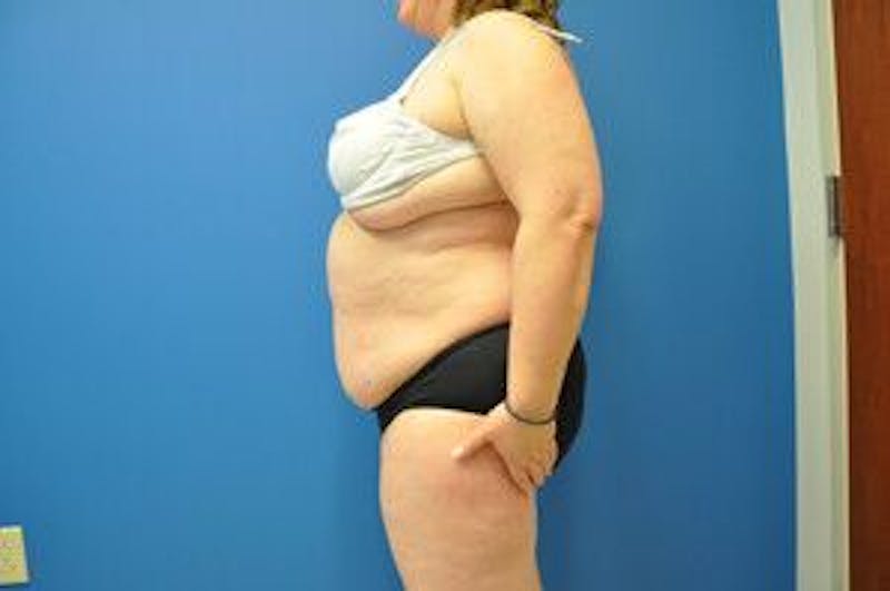 Liposonix Before & After Gallery - Patient 55345165 - Image 10