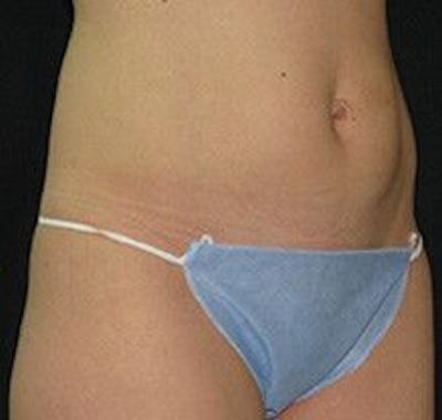 UltraShape Before & After Gallery - Patient 55345159 - Image 2