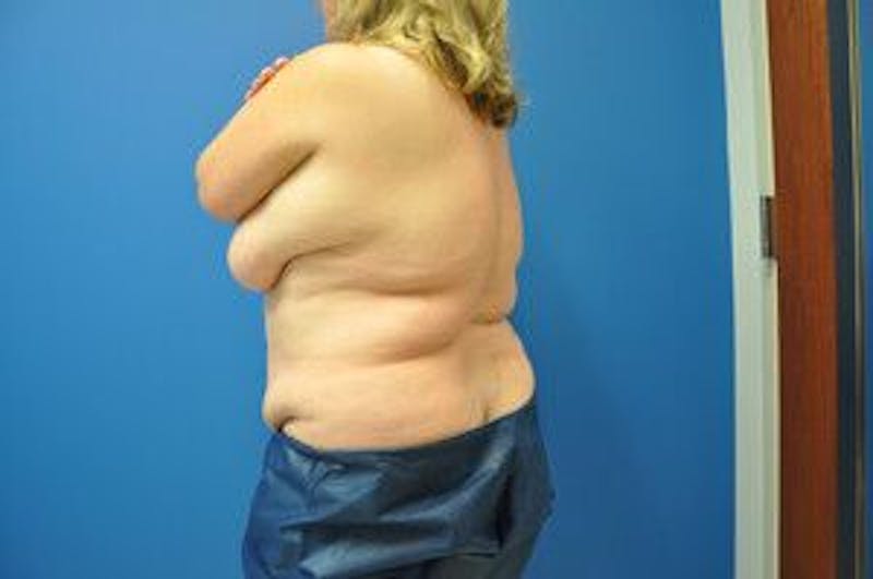 Liposonix Before & After Gallery - Patient 55345165 - Image 11