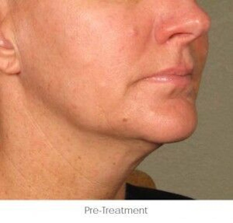 Ultherapy Before & After Gallery - Patient 55345162 - Image 1