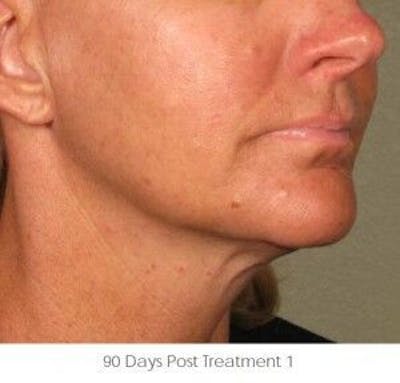 Ultherapy Before & After Gallery - Patient 55345162 - Image 2
