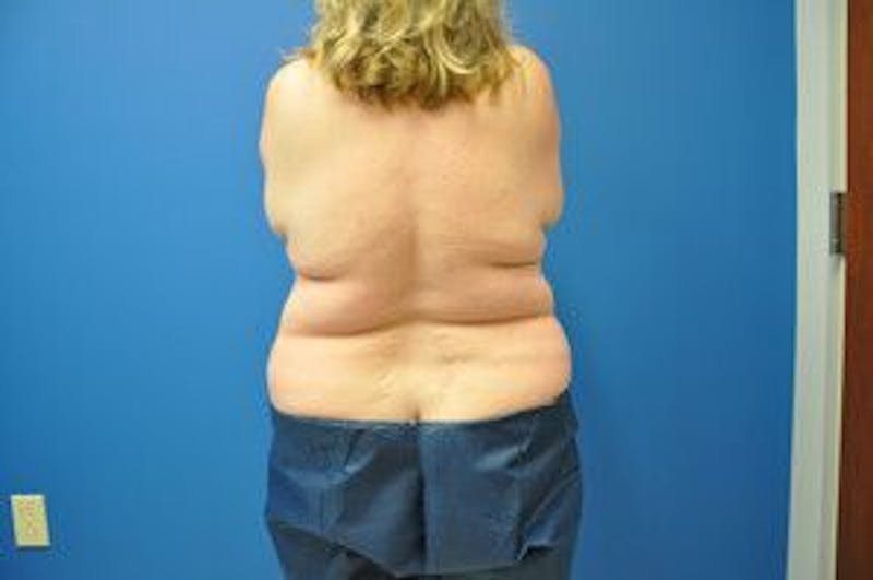 Liposonix Before & After Gallery - Patient 55345165 - Image 13