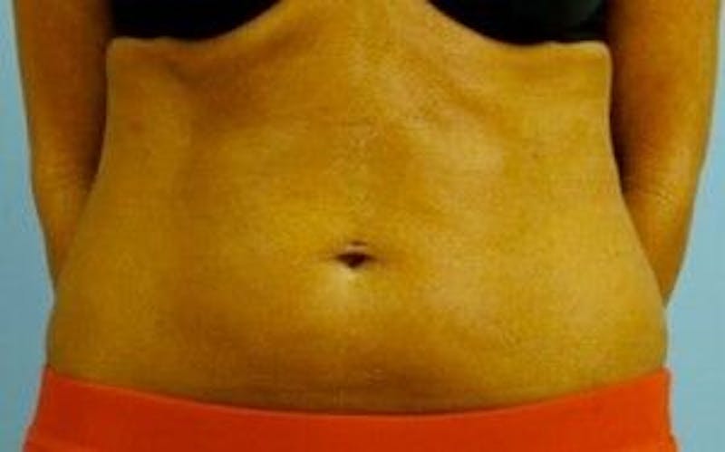 truSculpt Before & After Gallery - Patient 55345168 - Image 1