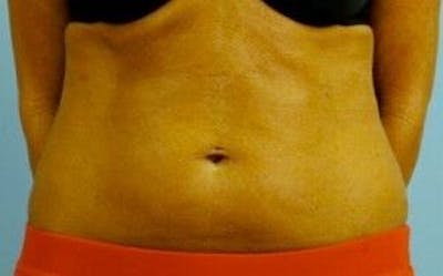 truSculpt Before & After Gallery - Patient 55345168 - Image 1