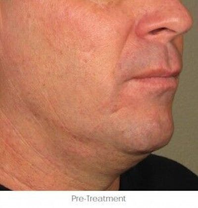 Ultherapy Gallery - Patient 55345166 - Image 1