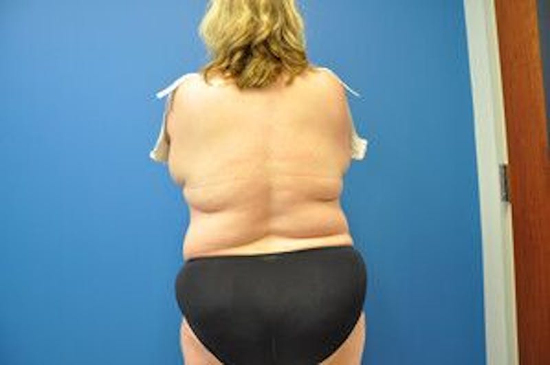 Liposonix Before & After Gallery - Patient 55345165 - Image 14