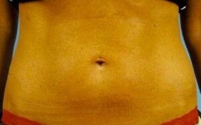 truSculpt Before & After Gallery - Patient 55345168 - Image 2