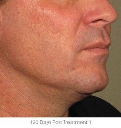 Ultherapy Before & After Gallery - Patient 55345166 - Image 2