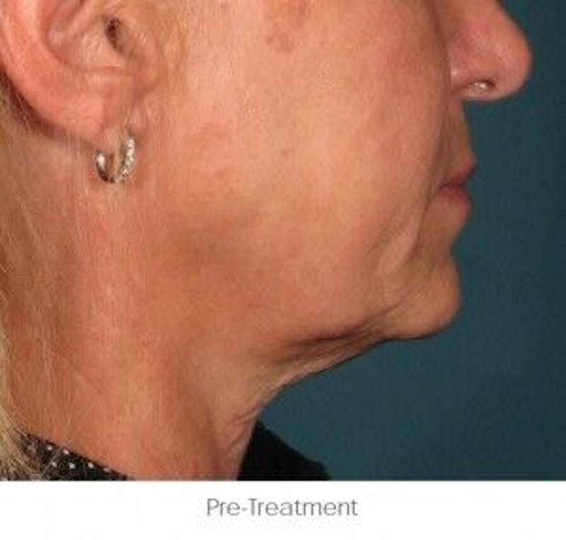 Ultherapy Before & After Gallery - Patient 55345169 - Image 1