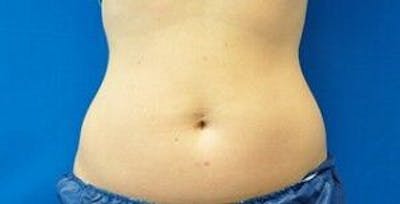 Liposonix Before & After Gallery - Patient 55345189 - Image 2