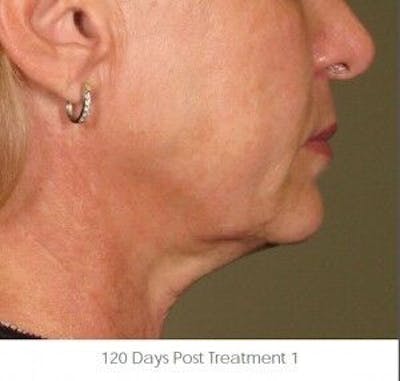 Ultherapy Gallery - Patient 55345169 - Image 2