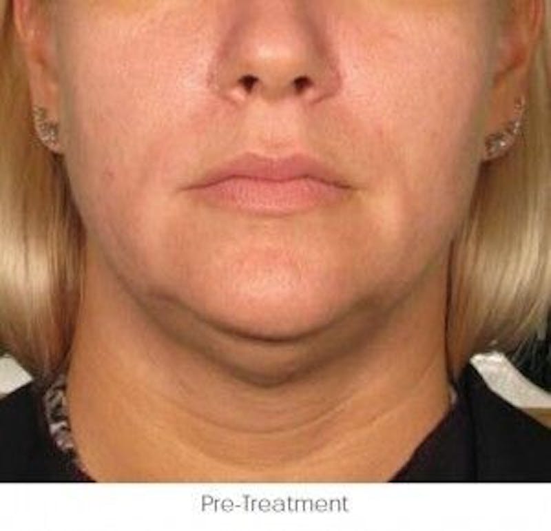 Ultherapy Before & After Gallery - Patient 55345174 - Image 1