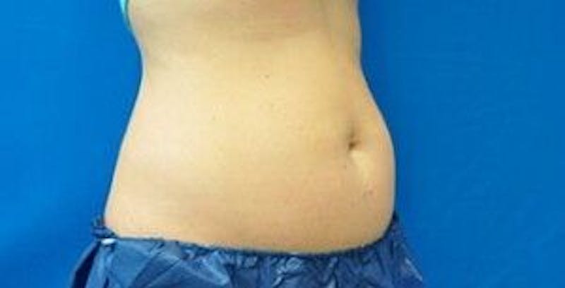 Liposonix Before & After Gallery - Patient 55345189 - Image 4