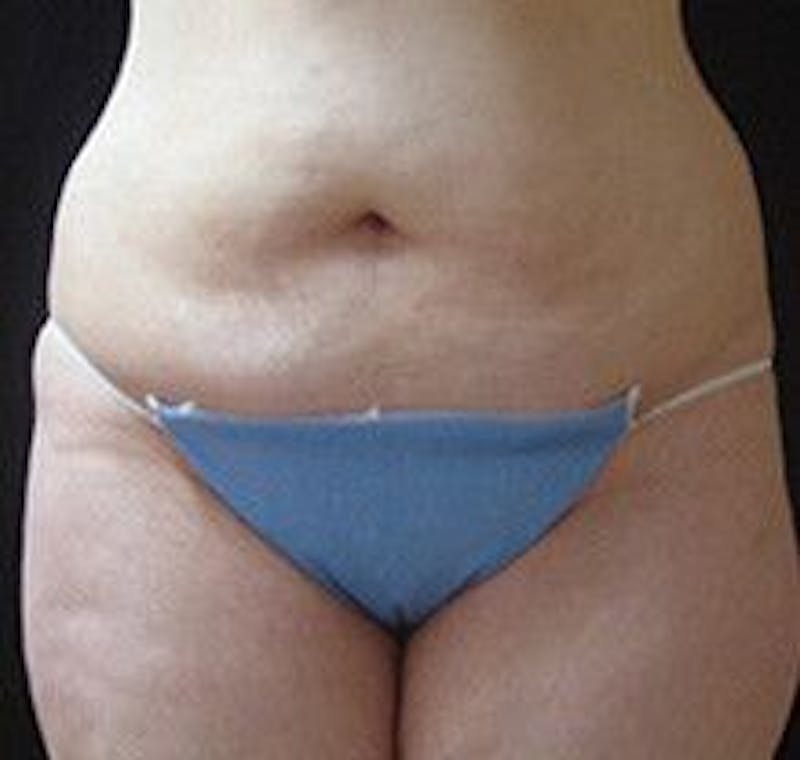 UltraShape Before & After Gallery - Patient 55345175 - Image 1