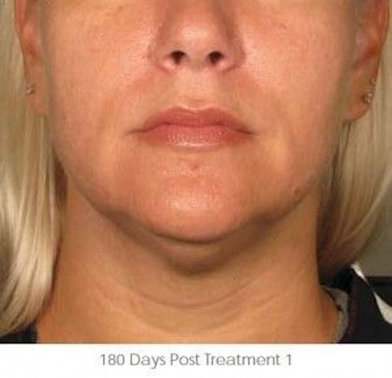 Ultherapy Before & After Gallery - Patient 55345174 - Image 2