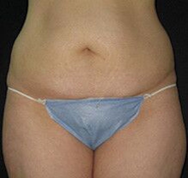 UltraShape Before & After Gallery - Patient 55345175 - Image 2