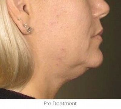 Ultherapy Before & After Gallery - Patient 55345180 - Image 1