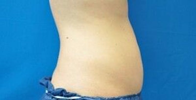 Liposonix Before & After Gallery - Patient 55345189 - Image 6