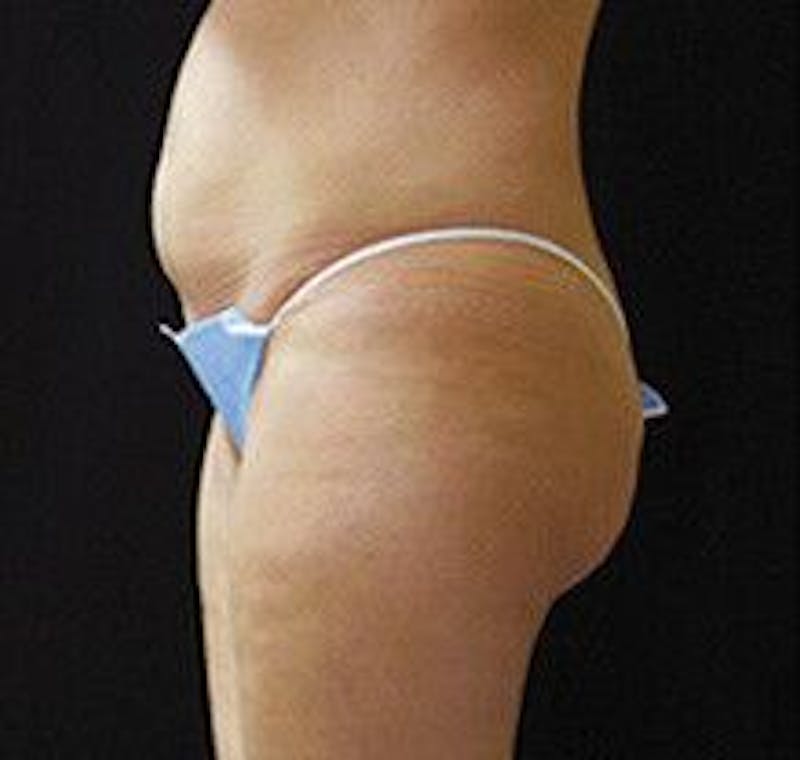 UltraShape Before & After Gallery - Patient 55345182 - Image 1