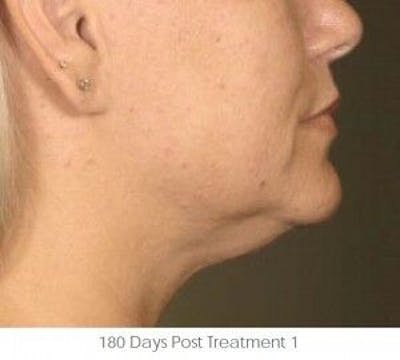 Ultherapy Before & After Gallery - Patient 55345180 - Image 2