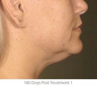 Ultherapy Before & After Gallery - Patient 55345180 - Image 2